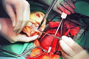 50 años de la primera operación de transplante de corazón