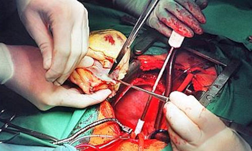 50 años de la primera operación de transplante de corazón