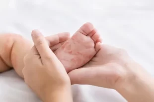 Sarampión